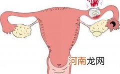 宫外孕可以不做手术吗优质