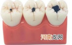 牙齿为什么老是蛀牙优质