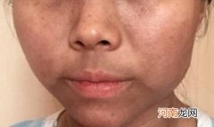 皮肤黑和暗沉的区别