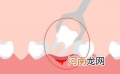 拔牙疼还是镶牙疼优质