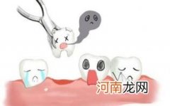 拔牙注意事项优质