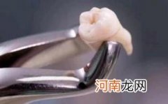 拔牙后什么情况下要吃药优质