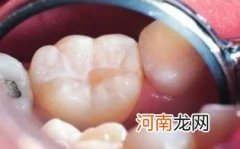 磨牙是缺什么微量元素优质