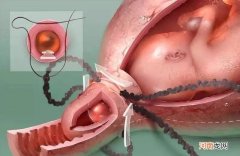 宫颈环扎后要卧床多久 女性结扎后要卧床几天