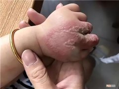 世界上最毒的虫子前十名 世界上最毒的虫子