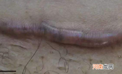 疤痕增生会自愈吗 增生性疤痕自己会好吗