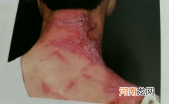 隐翅虫皮炎在脸上会毁容吗