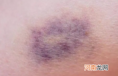 关于人体的知识科普 身体碰撞的地方为什么青紫