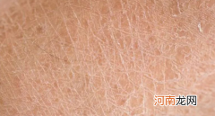 为什么皮肤上会有皮屑，头皮屑很多怎么办？