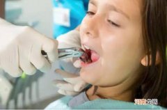 拔牙的最佳时间