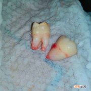 长智齿怎么办 6岁儿童长智齿怎么办