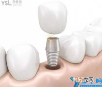 2022最新国产、进口种植牙价格表