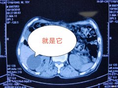 肾囊肿怎么办 肾有囊肿怎么办严重吗