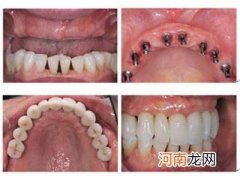 补牙多少钱 补牙多少钱一颗牙 能报销吗