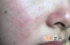 脸过敏怎么办 孩子化妆后脸过敏怎么办