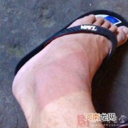 扭伤脚怎么办 下楼梯不小心踩空扭伤脚怎么办