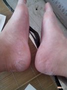 脚脱皮怎么办 鞋子闷脚脱皮怎么办