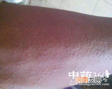 过敏怎么办 脸上过敏怎么办