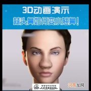 蒜头鼻怎么办 蒜头鼻怎么办不整容