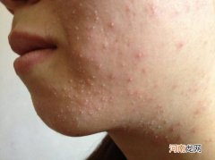痤疮怎么办 脸上反复长痤疮怎么办