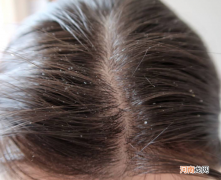 头皮痒怎么办 头皮痒怎么办最快最有效的方法