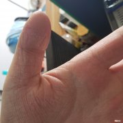 手蜕皮怎么办 手蜕皮怎么办 有一点点脱皮