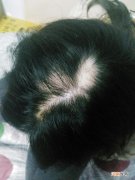 掉发怎么办 女生洗头发掉发怎么办