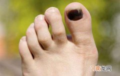 淤血怎么办 手被砸到了有淤血怎么办