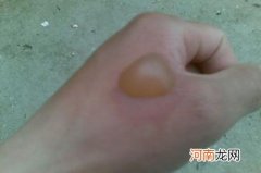 烫伤起泡怎么处理 碘伏消毒烫伤部位涂抹烫伤药膏