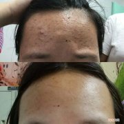 痤疮怎样治疗 光子痤疮怎样治疗