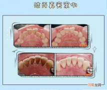 洗牙怎样洗 洗牙齿怎么洗
