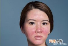 怎样去红血丝 怎样去红血丝什么药膏最好?
