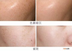 怎样美白祛斑 女人怎样美白祛斑