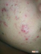 怎样治疗痘痘 怎样治疗痘痘和痘印