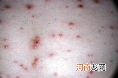 怎么判断是否得了水痘 为什么长水痘