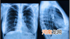 2021肺癌靶向药价格一览表 肺癌靶向药有哪些