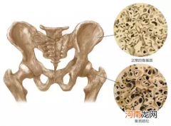 老人打骨水泥后期护理 压缩性骨折一般躺多久
