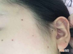 痣长在哪里 痣长在哪里好