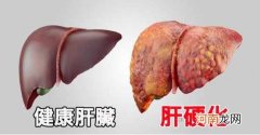 得了肝硬化还可以活多久？ 肝硬化会死吗