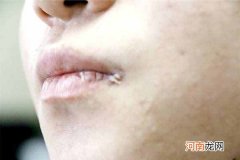 为什么嘴角总是频繁起泡？ 上火嘴唇起泡