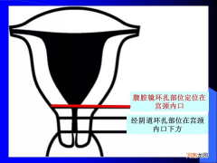 宫颈在哪里 女性宫颈在哪里