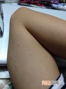 哪里痒一抓就很多疙瘩是过敏吗 哪里痒