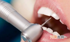 抠牙结石工具叫什么