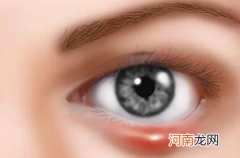 麦粒肿是什么原因引起