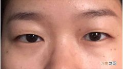 双眼皮手术 割个双眼皮多少钱