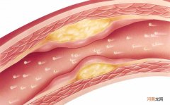 脑血栓长期吃什么药好 脑血栓吃什么药