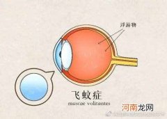 高度近视飞蚊症要紧吗 飞蚊症怎么治疗恢复