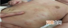 宝宝退烧后全身起红点是怎么回事