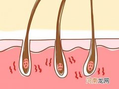 为什么生了孩子会脱发严重 产后三个月脱发严重是怎么回事