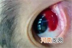眼睛红红的像出血一样可能是结膜下出血